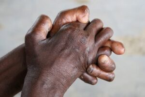 काठमाण्डौ महानगरमा कुष्ठरोगका एक सय १० जना बिरामी भेटिए